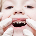 Tình trạng sâu răng sữa ở trẻ dưới 5 tuổi một phần là do thói quen của người lớn