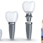 Cấy ghép răng bằng phương pháp Implant cho người cao tuổi
