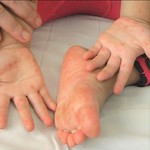 Đề phòng nguy cơ biến chứng bệnh tay chân miệng như thế nào?