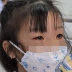 Đau mắt đỏ ở trẻ gia tăng, cảnh báo tình trạng dùng kháng sinh bừa bãi