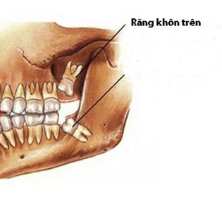 Theo dõi và xử lý răng khôn như thế nào?